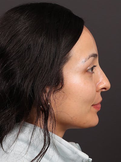 Primary Rhinoplasty Before & After Gallery - Patient 319902 - Image 1