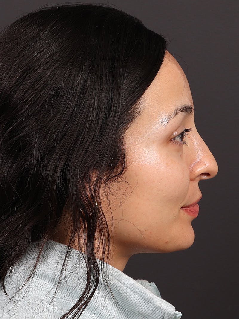 Primary Rhinoplasty Before & After Gallery - Patient 319902 - Image 1
