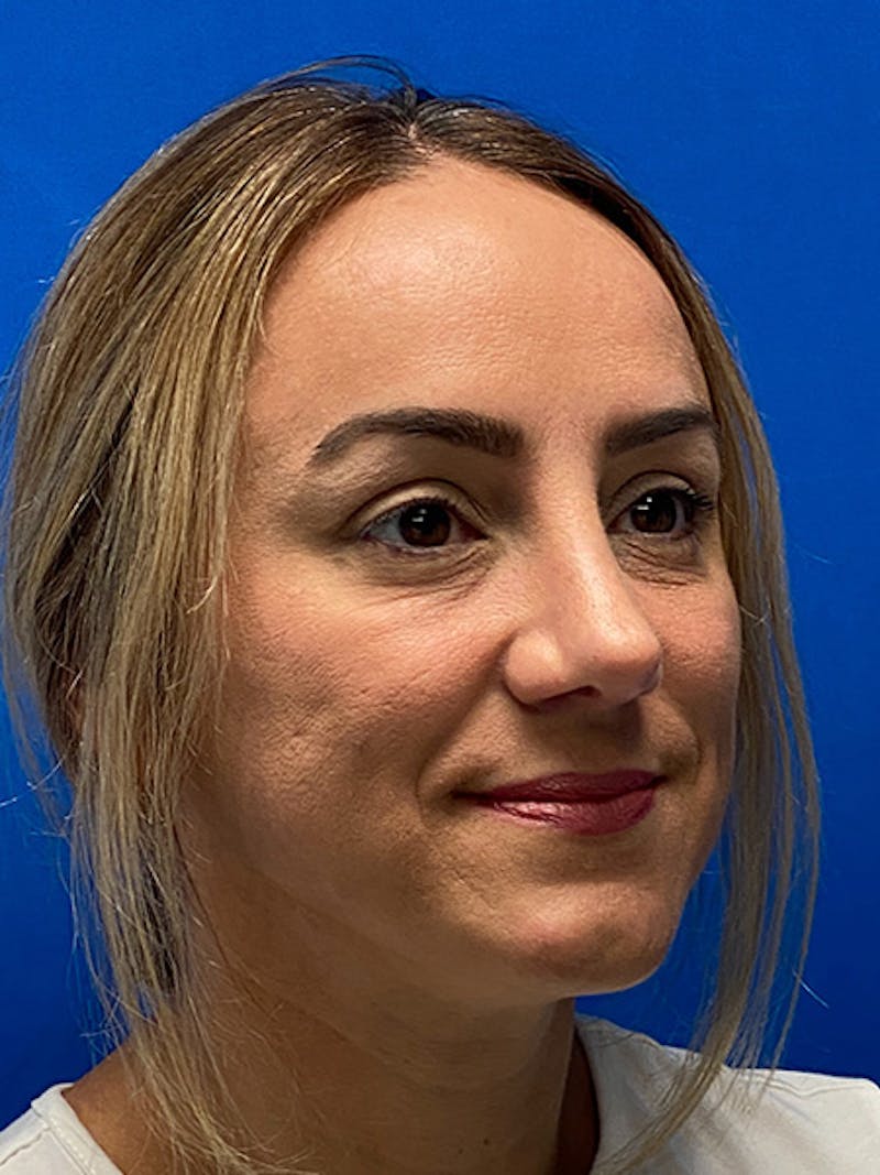 Primary Rhinoplasty Before & After Gallery - Patient 784658 - Image 10