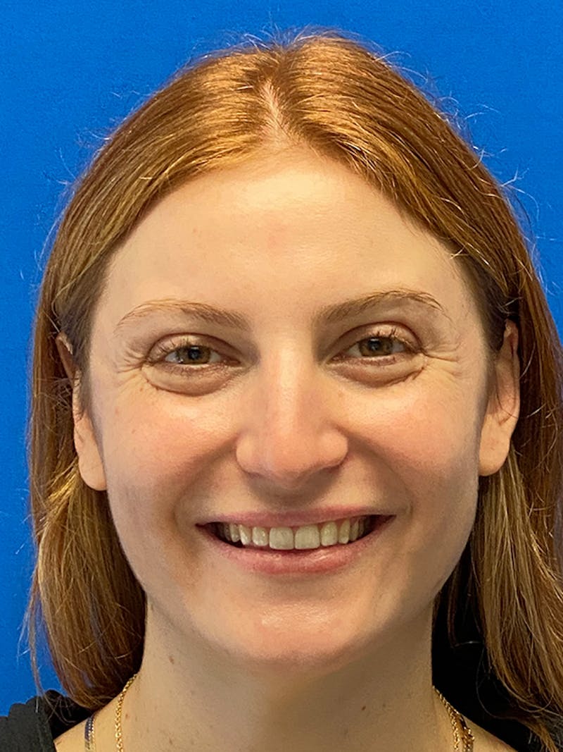 Primary Rhinoplasty Before & After Gallery - Patient 202446 - Image 5