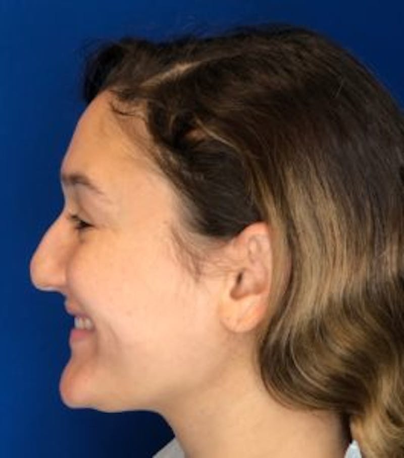 Primary Rhinoplasty Before & After Gallery - Patient 320169 - Image 11
