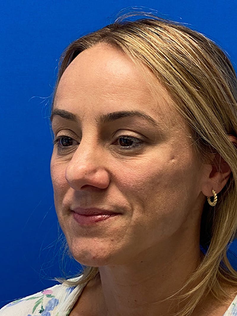 Primary Rhinoplasty Before & After Gallery - Patient 784658 - Image 7