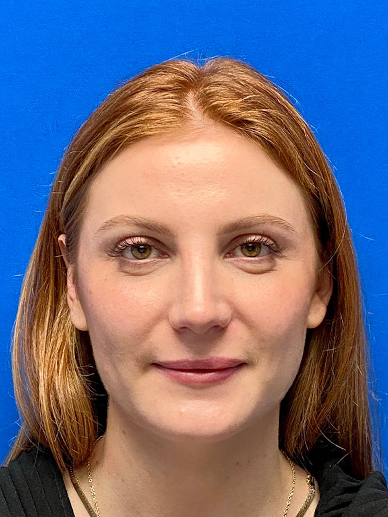 Primary Rhinoplasty Before & After Gallery - Patient 202446 - Image 4