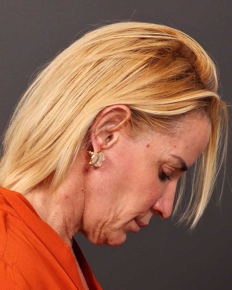 Facelift Before & After Gallery - Patient 965600 - Image 7