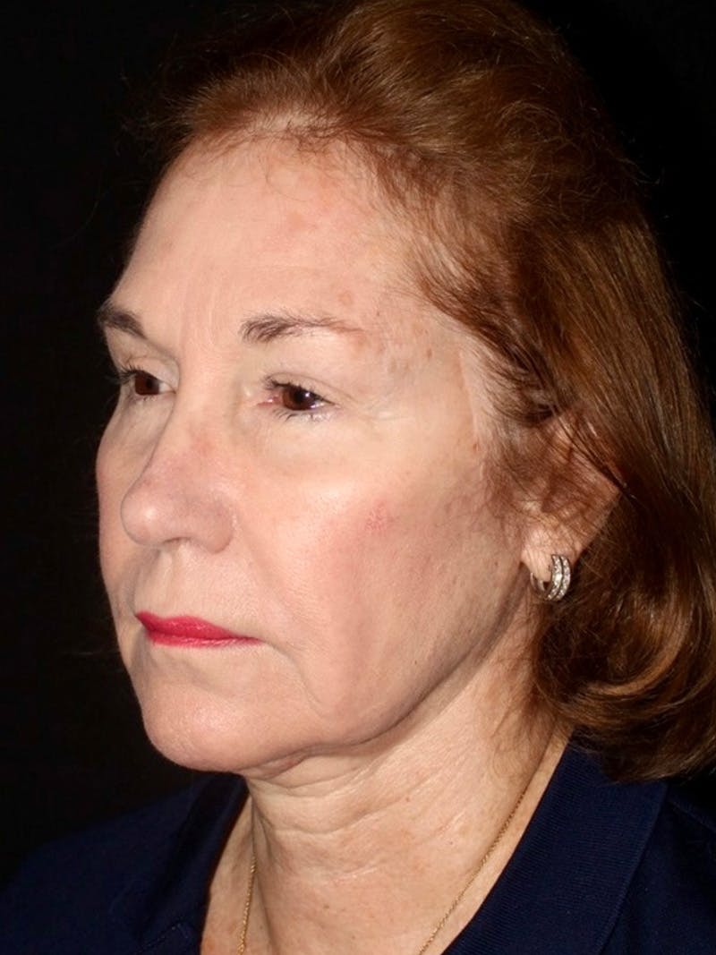 Facelift Before & After Gallery - Patient 349569 - Image 3