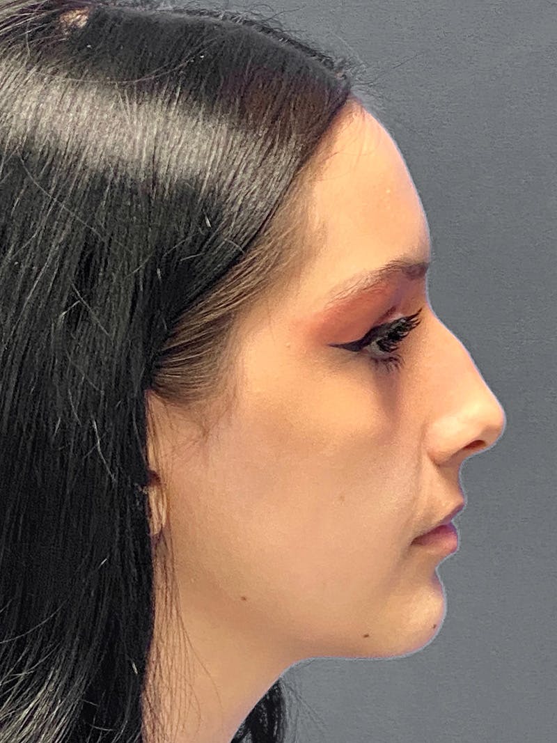 Primary Rhinoplasty Before & After Gallery - Patient 330004 - Image 1