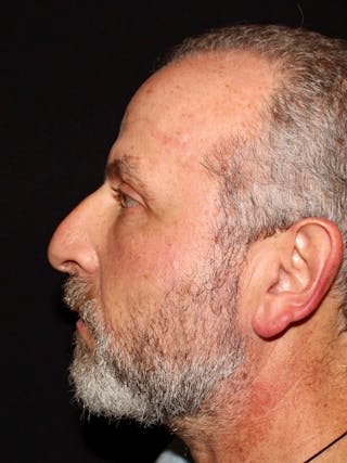Blepharoplasty Before & After Gallery - Patient 669983 - Image 8