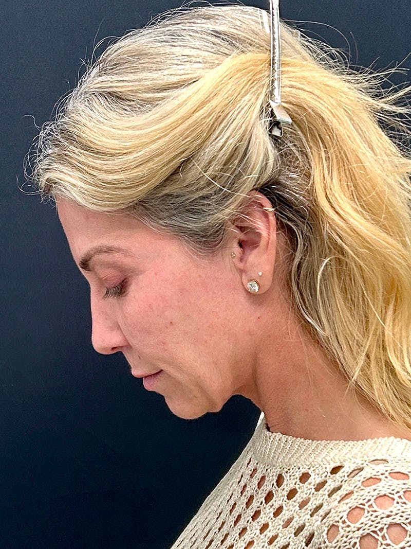 Facelift Before & After Gallery - Patient 420053 - Image 7