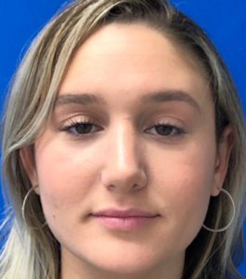 Primary Rhinoplasty Before & After Gallery - Patient 320169 - Image 6
