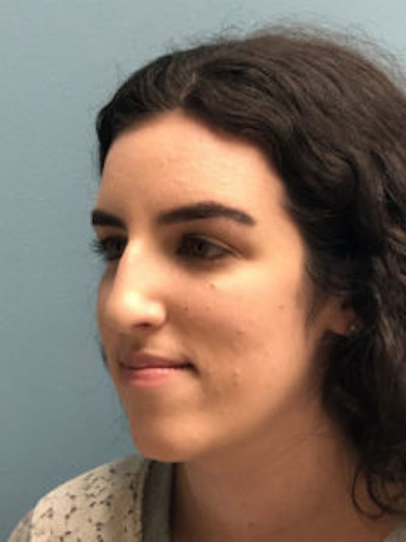 Primary Rhinoplasty Before & After Gallery - Patient 173090 - Image 5