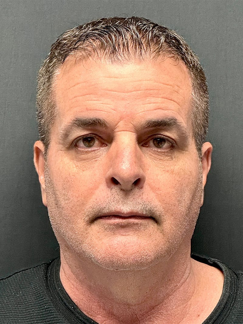 Blepharoplasty Before & After Gallery - Patient 316919 - Image 1