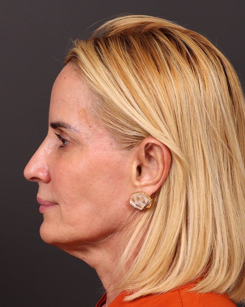 Facelift Before & After Gallery - Patient 965600 - Image 5