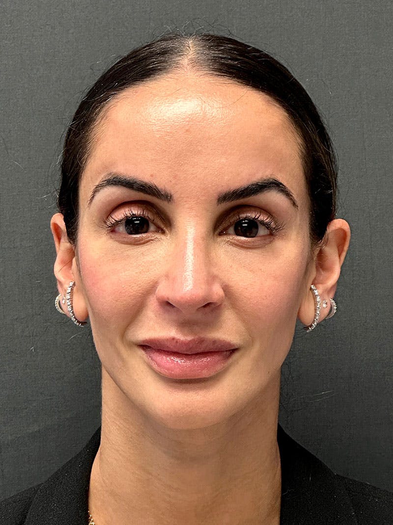 Brow Lift Before & After Gallery - Patient 183593 - Image 2