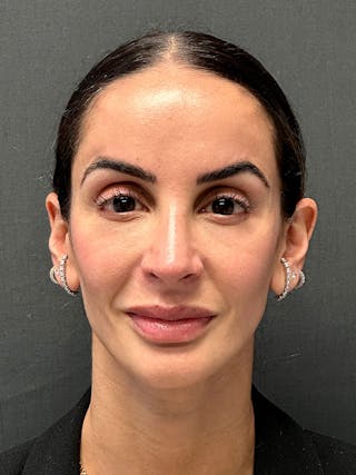 Primary Rhinoplasty Before & After Gallery - Patient 226366 - Image 4
