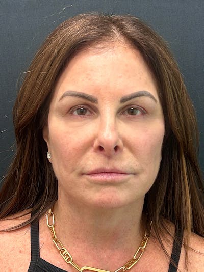 Brow Lift Before & After Gallery - Patient 144604 - Image 2