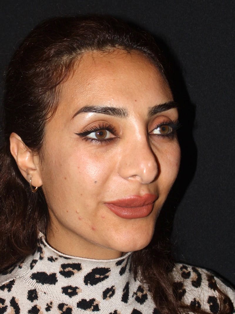 Revision Rhinoplasty Before & After Gallery - Patient 319821 - Image 5