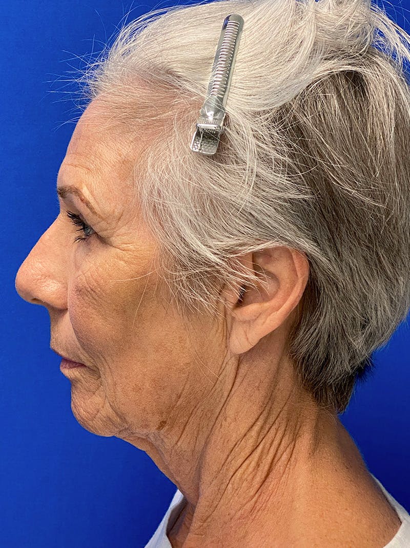 Facelift Before & After Gallery - Patient 349518 - Image 5