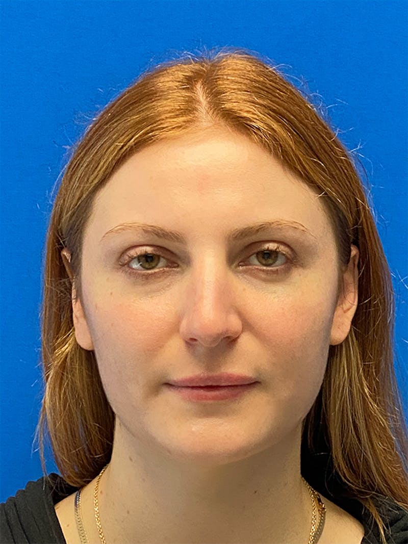 Primary Rhinoplasty Before & After Gallery - Patient 202446 - Image 3