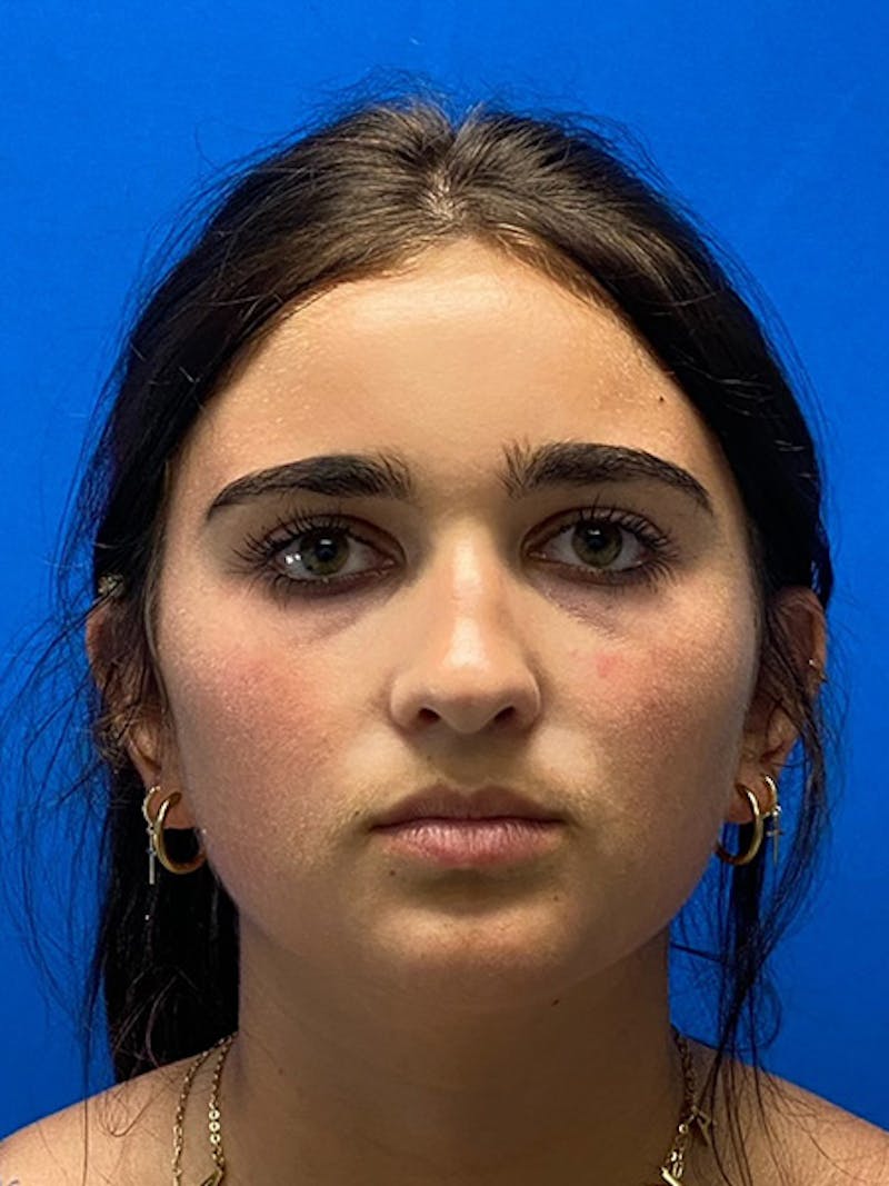 Primary Rhinoplasty Before & After Gallery - Patient 401318 - Image 3