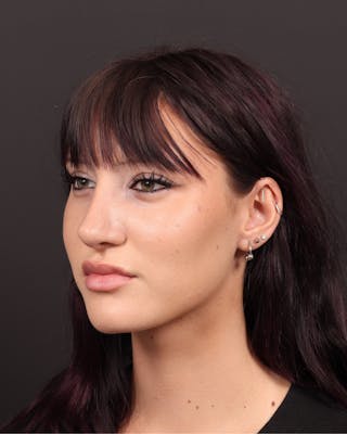 Primary Rhinoplasty Before & After Gallery - Patient 420494 - Image 10
