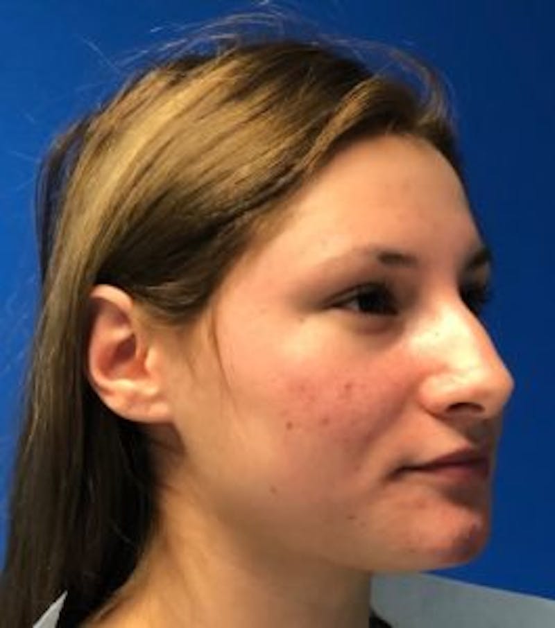 Primary Rhinoplasty Before & After Gallery - Patient 550195 - Image 7