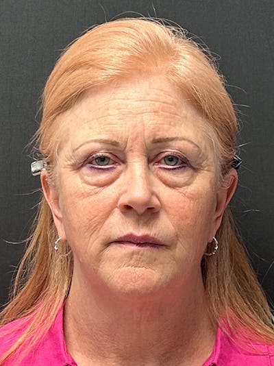 Facelift Before & After Gallery - Patient 104254 - Image 1