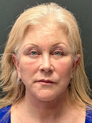 Facelift Before & After Gallery - Patient 104254 - Image 2