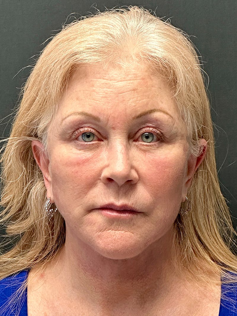 Facelift Before & After Gallery - Patient 104254 - Image 2