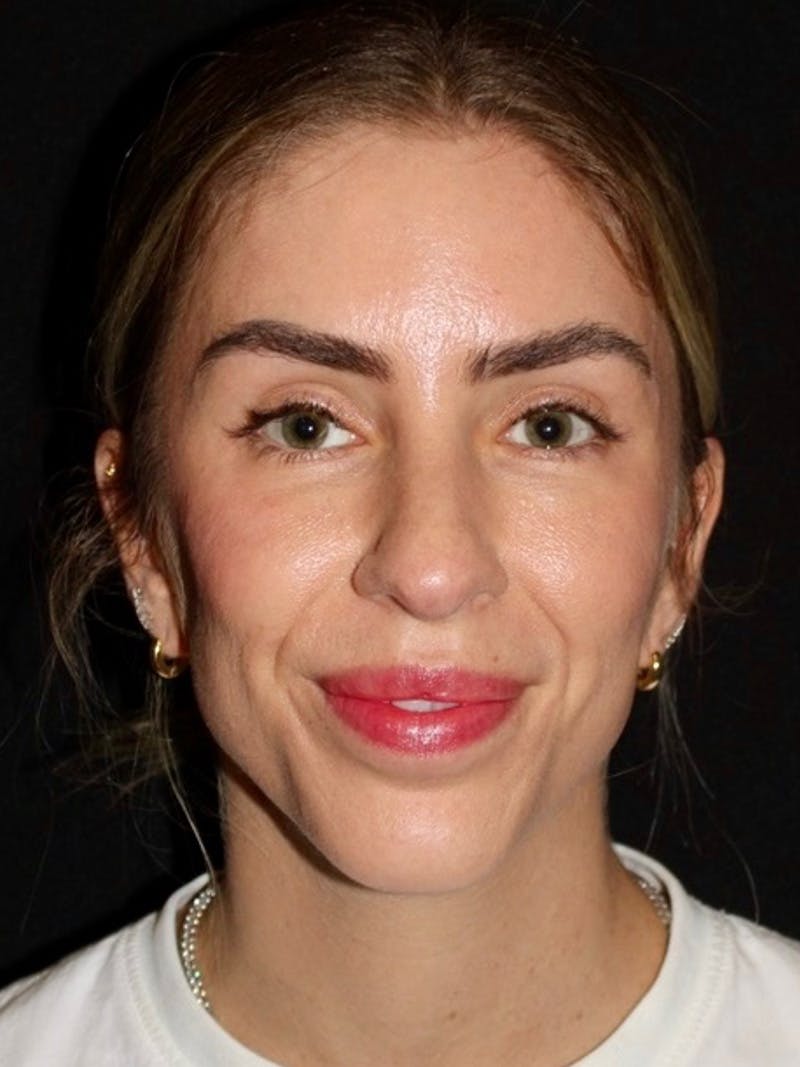Brow Lift  Before & After Gallery - Patient 260378 - Image 2