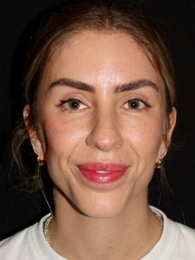 Brow Lift Before & After Gallery - Patient 386431 - Image 2