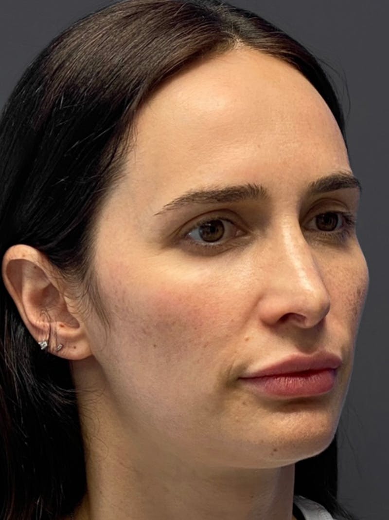 Revision Rhinoplasty Before & After Gallery - Patient 240059 - Image 5