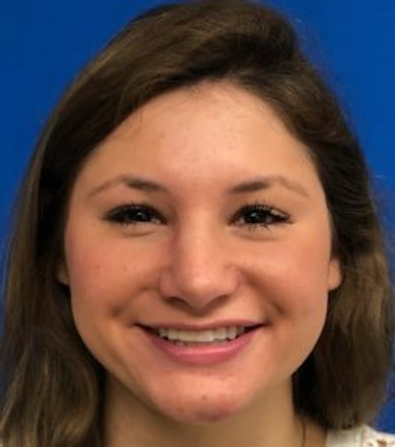 Primary Rhinoplasty Before & After Gallery - Patient 550195 - Image 4