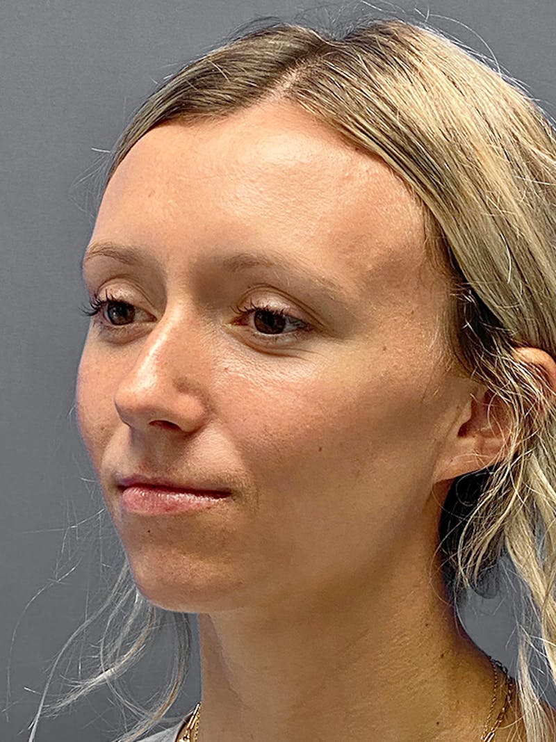 Chin Augmentation Before & After Gallery - Patient 142902 - Image 5