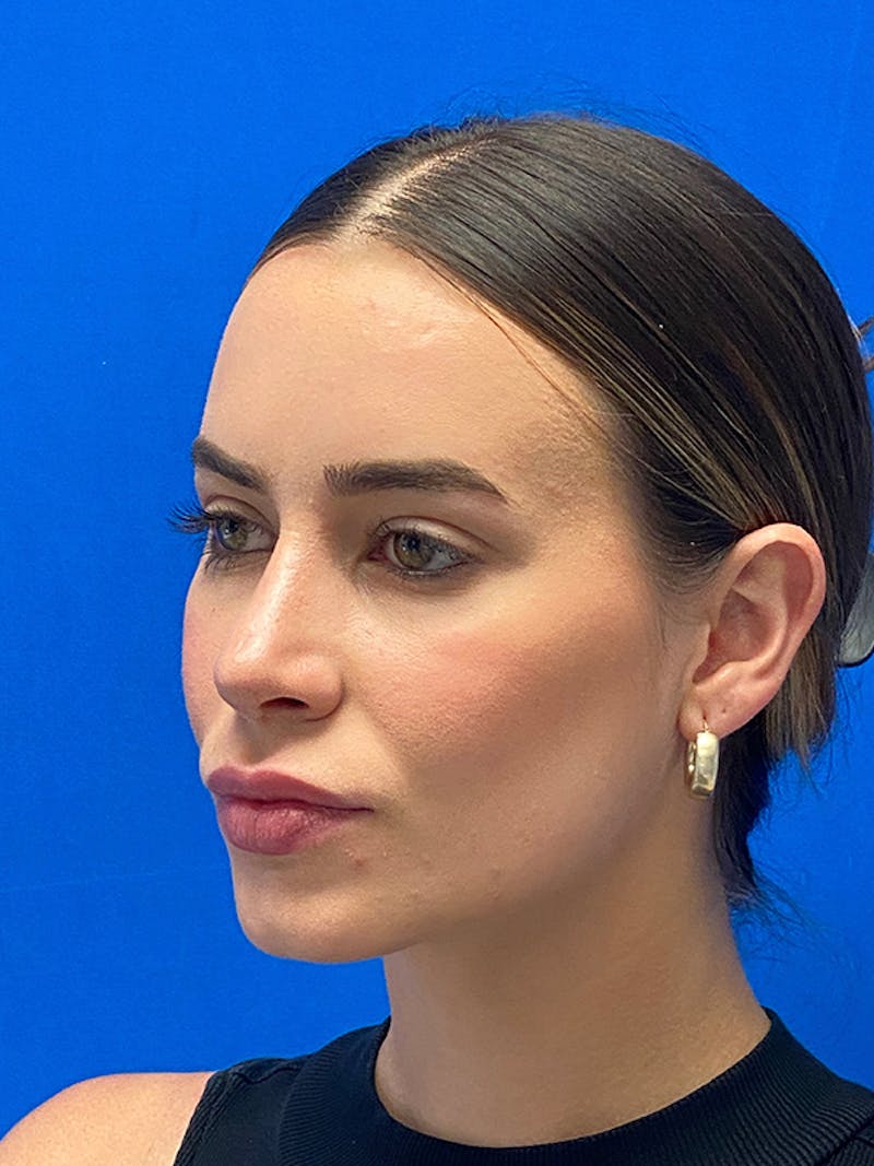 Primary Rhinoplasty Before & After Gallery - Patient 235266 - Image 6