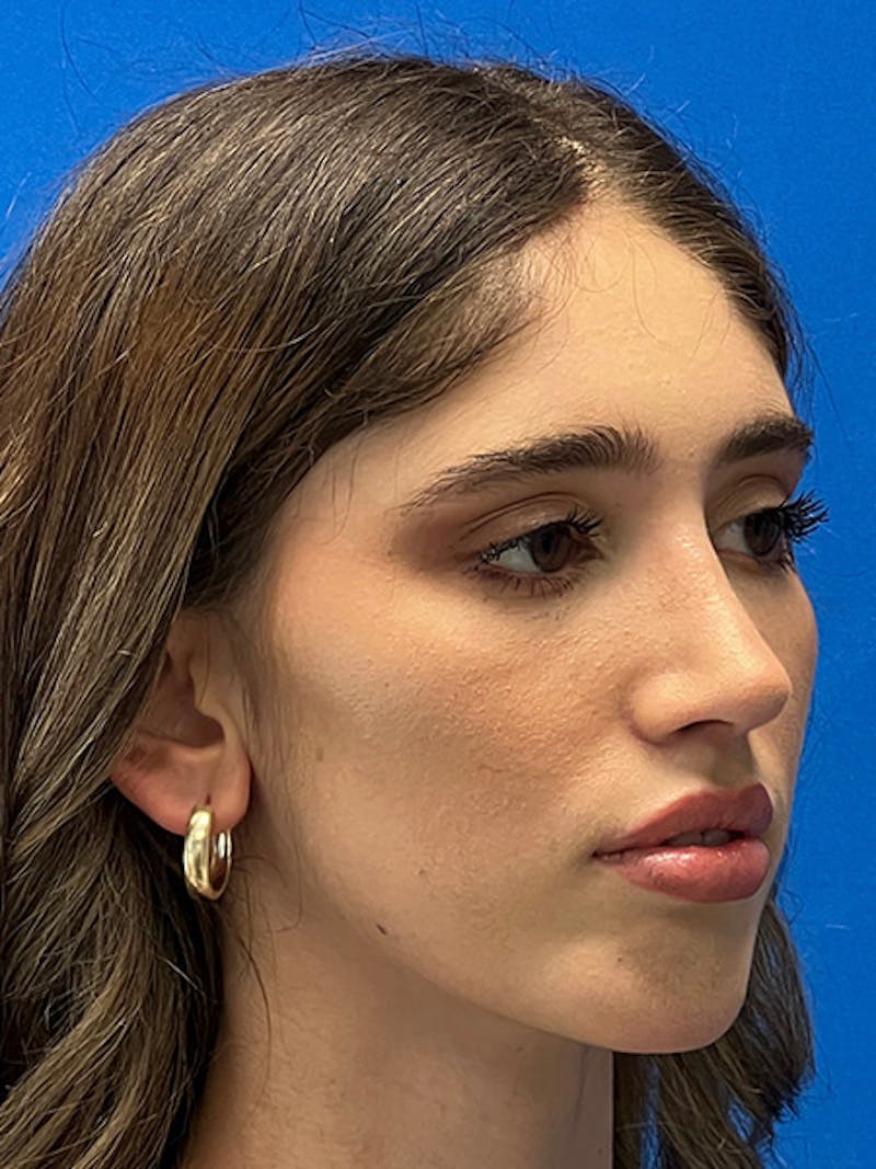 Primary Rhinoplasty Before & After Gallery - Patient 342098 - Image 6