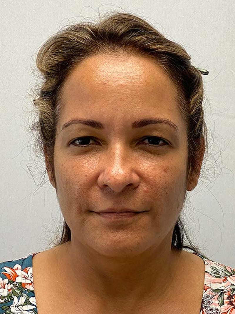 Facelift Before & After Gallery - Patient 181295 - Image 1