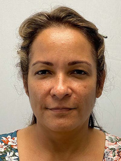 Facelift Before & After Gallery - Patient 181295 - Image 1