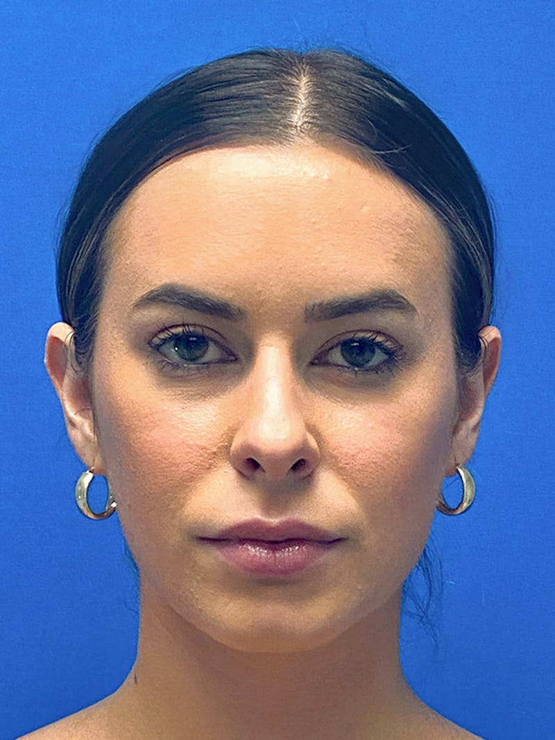 Primary Rhinoplasty Before & After Gallery - Patient 235266 - Image 3
