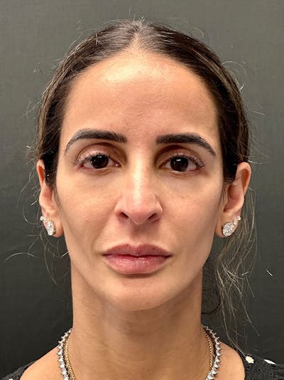 Brow Lift Before & After Gallery - Patient 183593 - Image 1