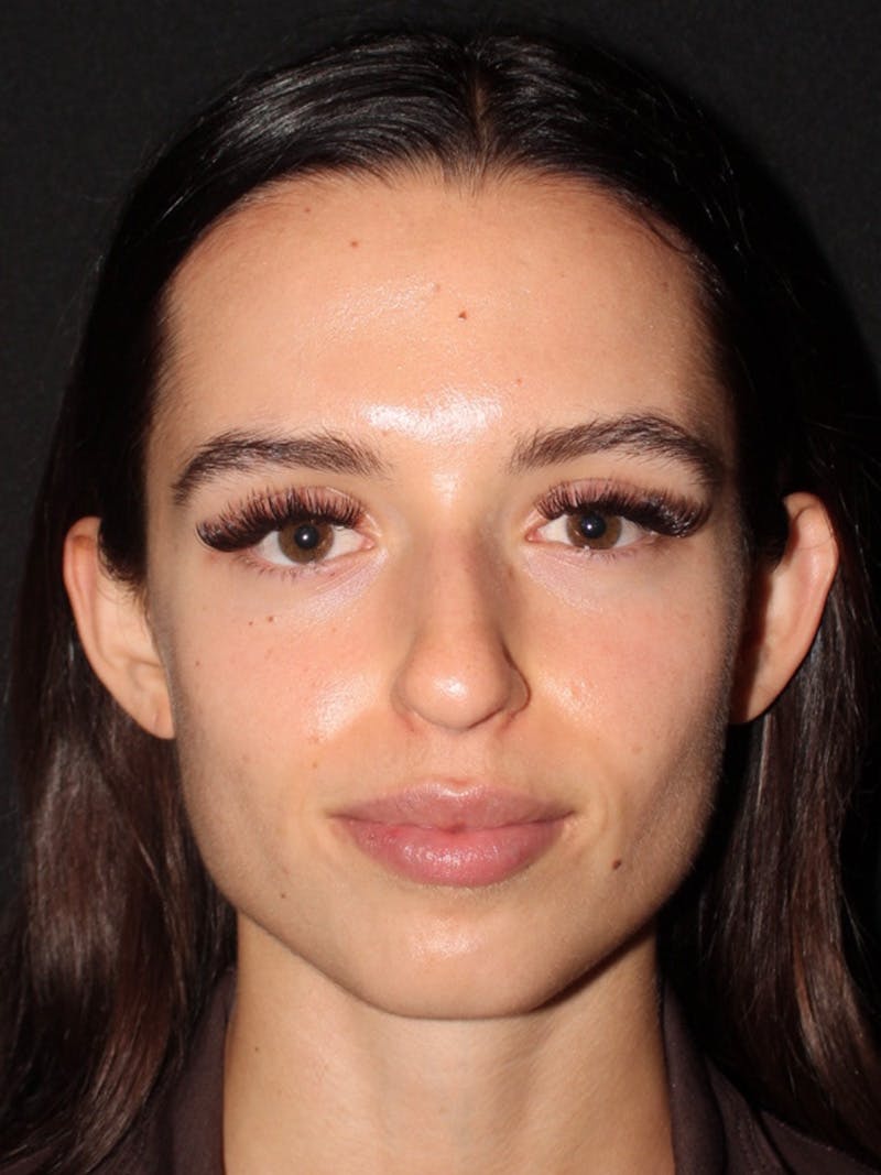 Primary Rhinoplasty Before & After Gallery - Patient 245621 - Image 3