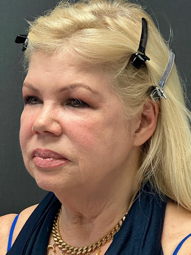 Facelift Before & After Gallery - Patient 112257 - Image 3