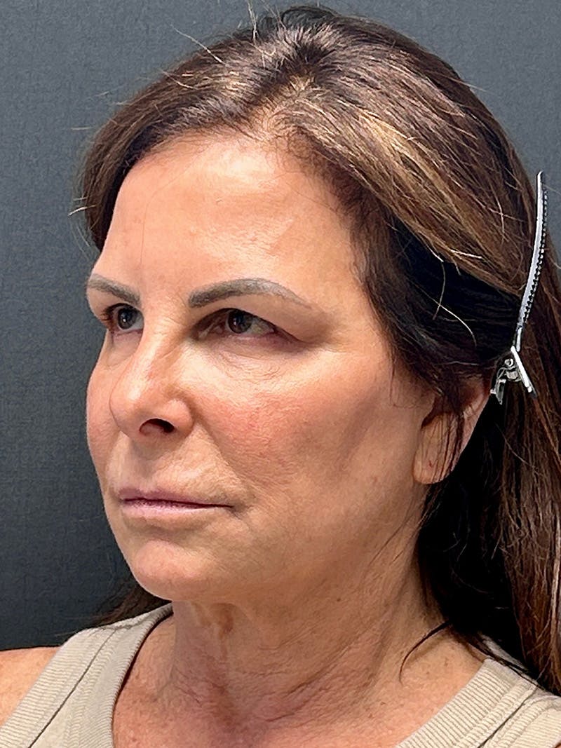Neck Lift Before & After Gallery - Patient 362491 - Image 3