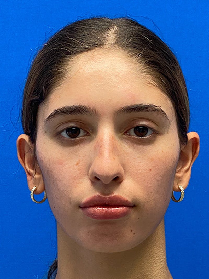 Primary Rhinoplasty Before & After Gallery - Patient 342098 - Image 3