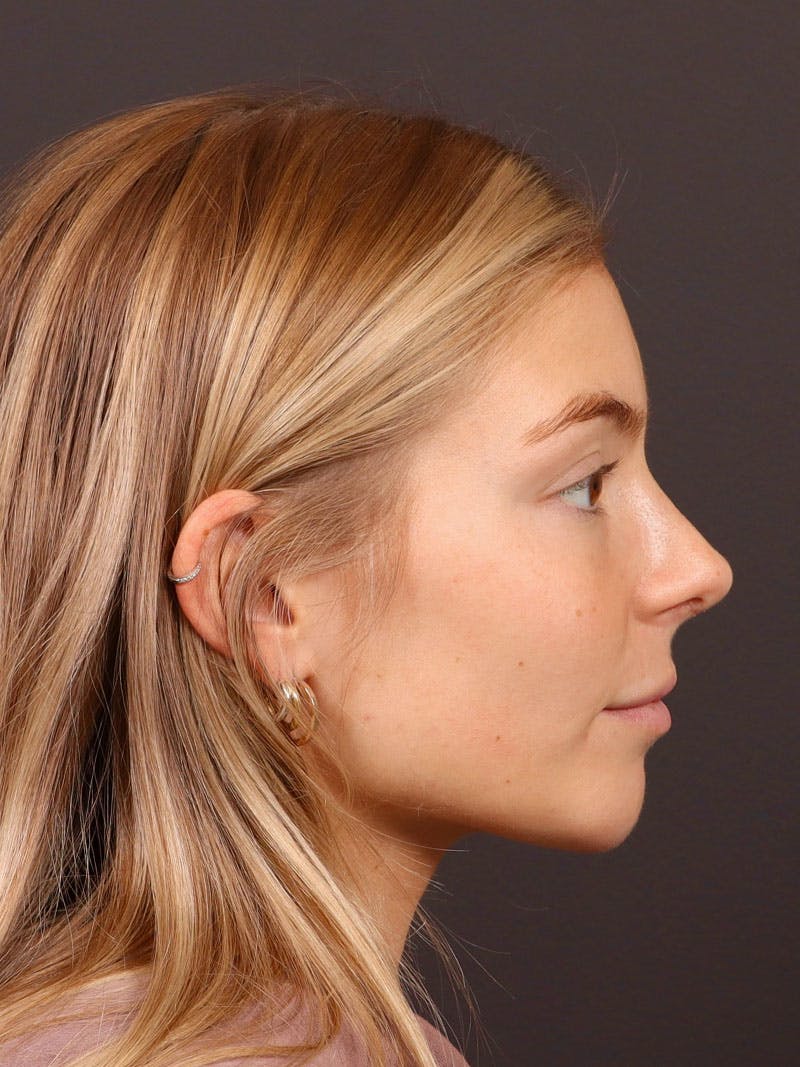 Primary Rhinoplasty Before & After Gallery - Patient 194014 - Image 2