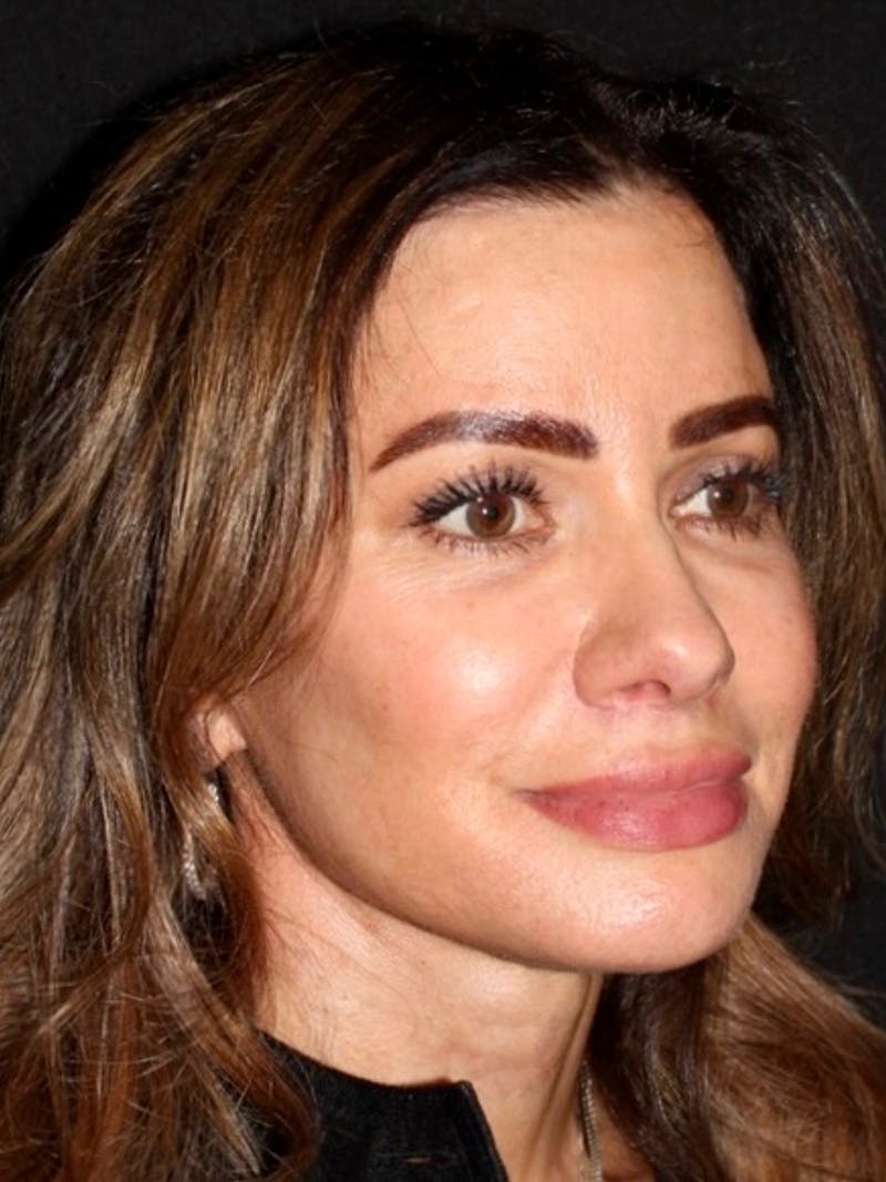 Brow Lift Before & After Gallery - Patient 387096 - Image 4