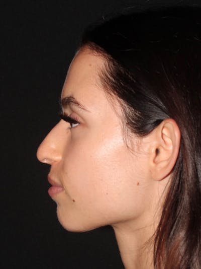 Primary Rhinoplasty Before & After Gallery - Patient 245621 - Image 1