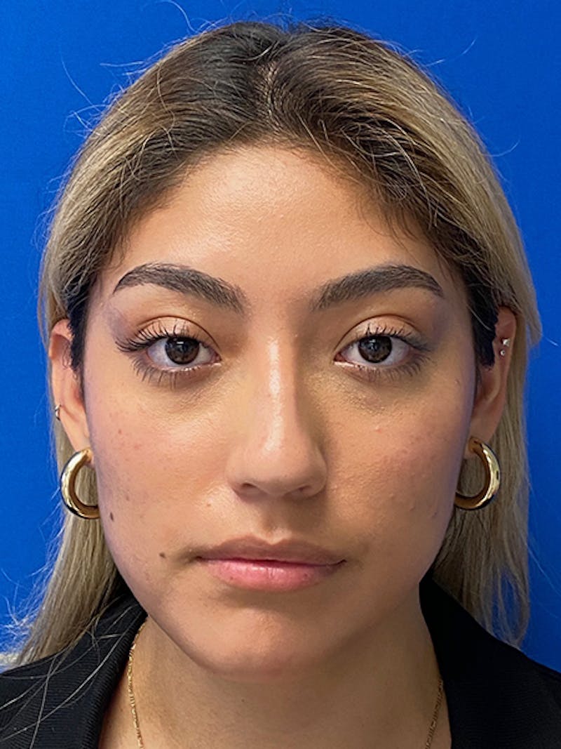 Primary Rhinoplasty Before & After Gallery - Patient 317021 - Image 3
