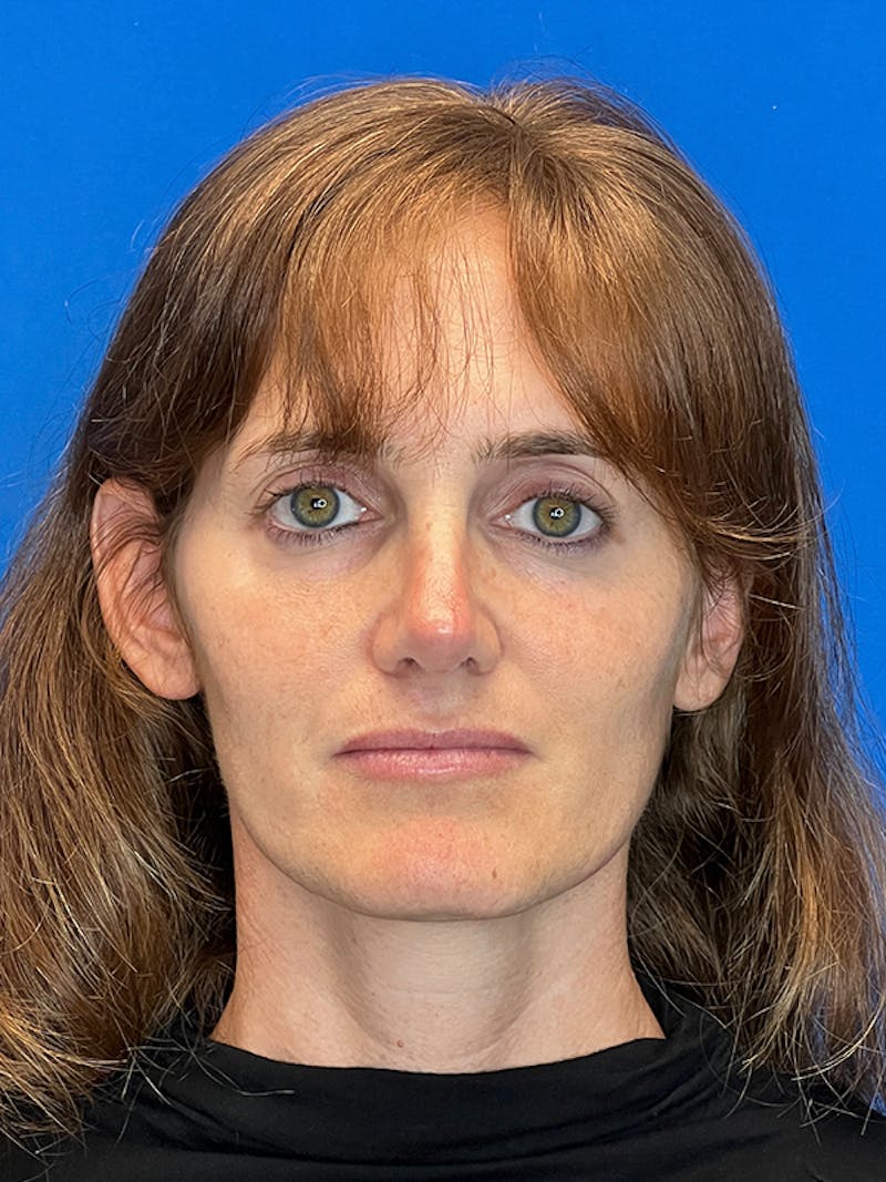 Revision Rhinoplasty Before & After Gallery - Patient 330413 - Image 4