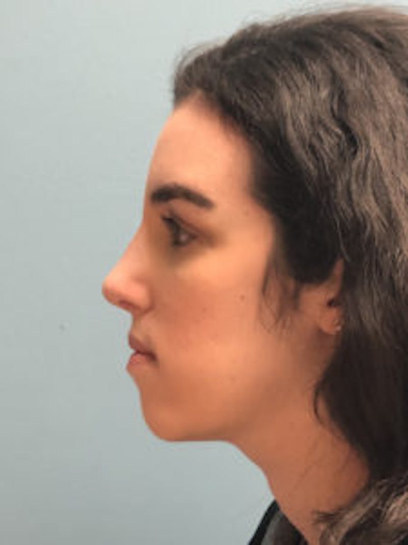 Primary Rhinoplasty Before & After Gallery - Patient 173090 - Image 8