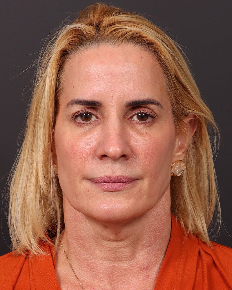 Facelift Before & After Gallery - Patient 965600 - Image 1